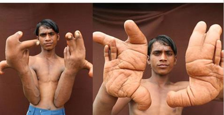 এক ফুট লম্বা আঙুল, ‘শয়তান’ বলে পরিচিত এই কিশোর