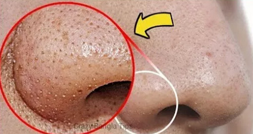 ছেলেদের জানা দরকারঃ- মাত্র ১ বারে নাক থেকে সকল ধরনের সাদা ও কালো শাল দূর করার উপায়।